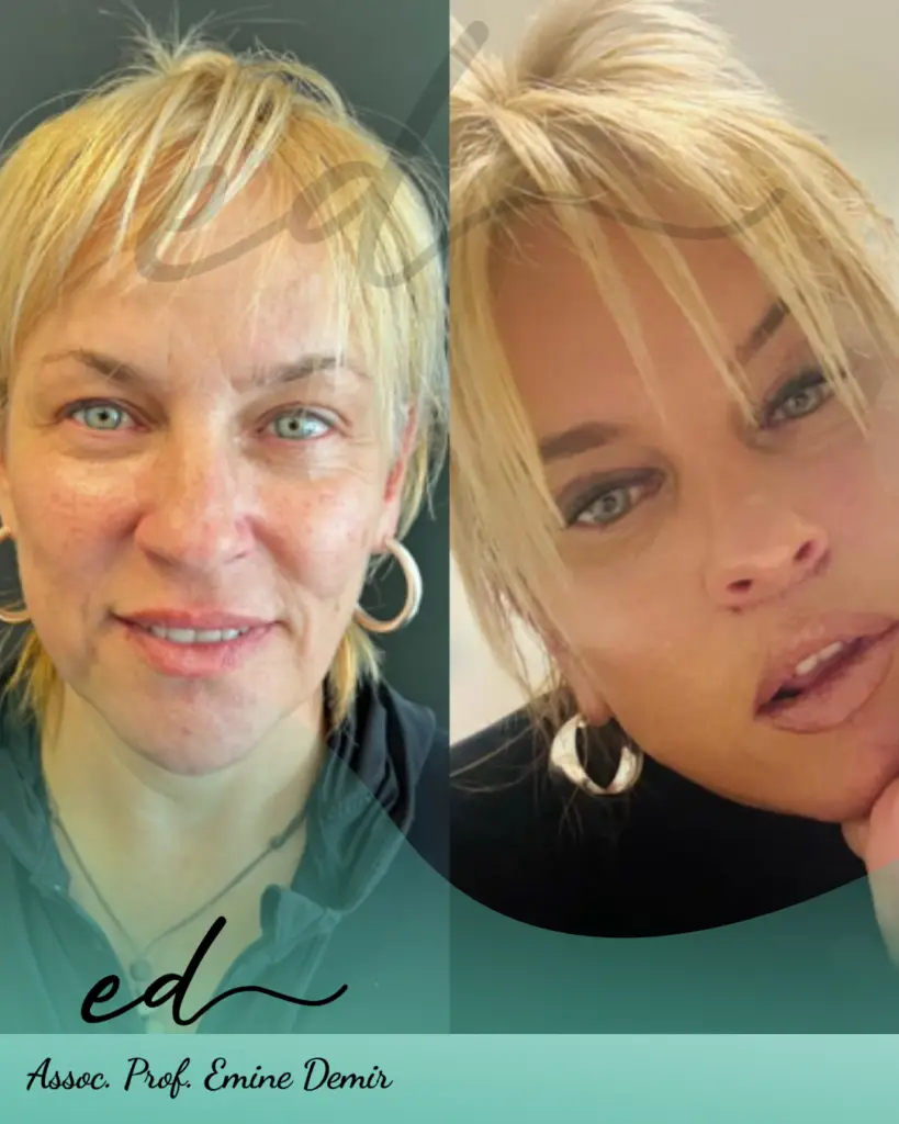 Assoc. Prof. Emine Demir - Face Surgery Before After