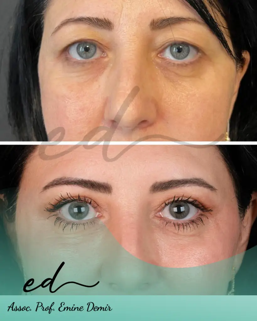 Assoc. Prof. Emine Demir - Face Surgery Before After