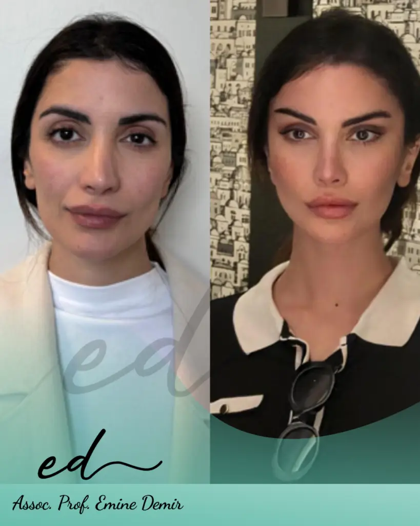 Assoc. Prof. Emine Demir - Face Surgery Before After