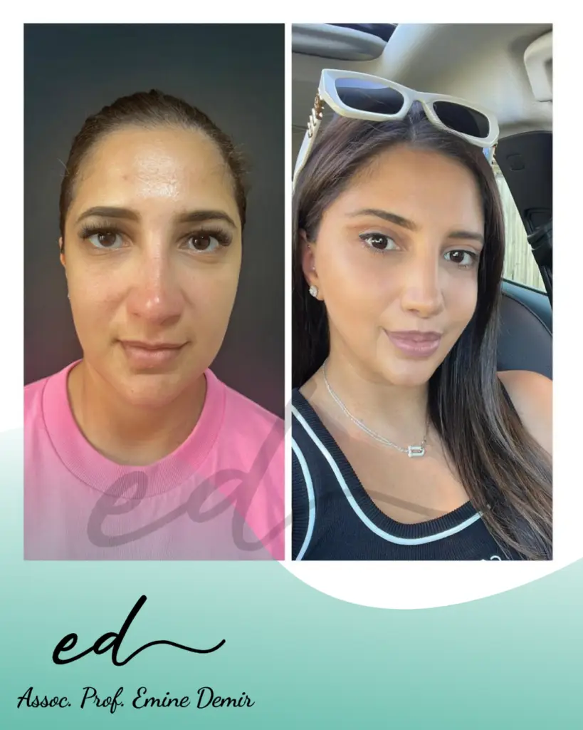 Assoc. Prof. Emine Demir - Face Surgery Before After